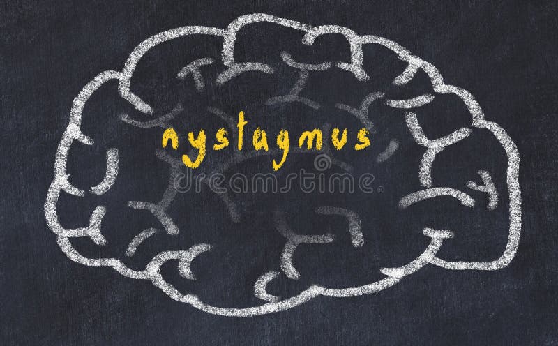 Nystagmus Stock Illustrations – 59 Nystagmus Stock Illustrations, Vectors &  Clipart - Dreamstime