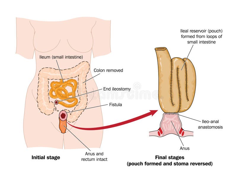 Drawing of rectal pouch after bowel removal stock illustration