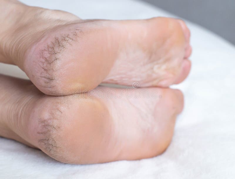 Follow These 6 Steps To Heal Cracked Heels Easily and Effectively