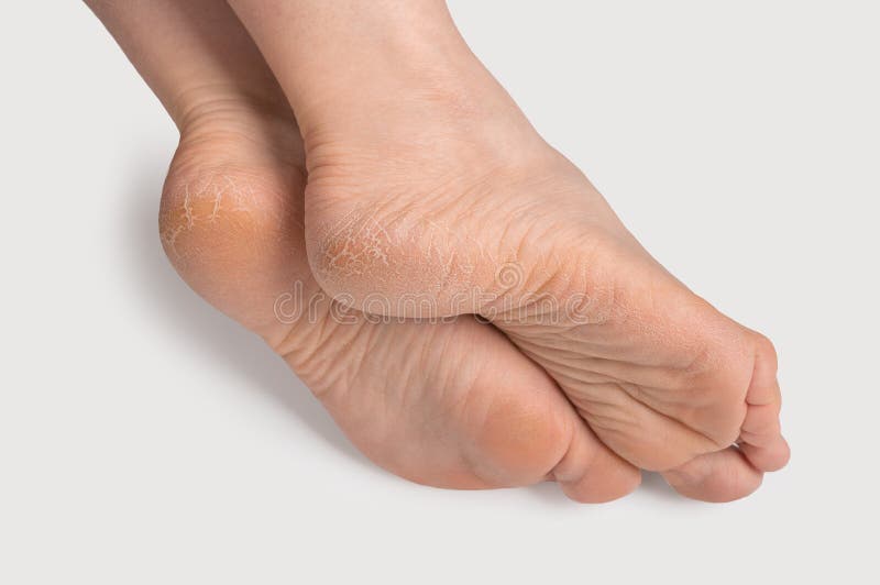 Ways To Prevent And Get Rid Of Dry, Cracked Feet This Winter