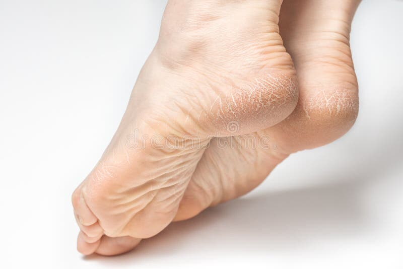 cracked soles of feet