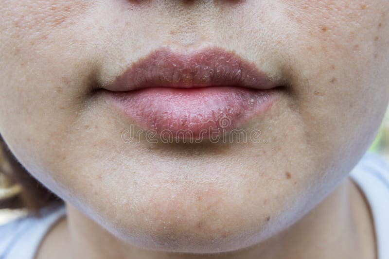 Dry lips, Lack of skin lips maintenance