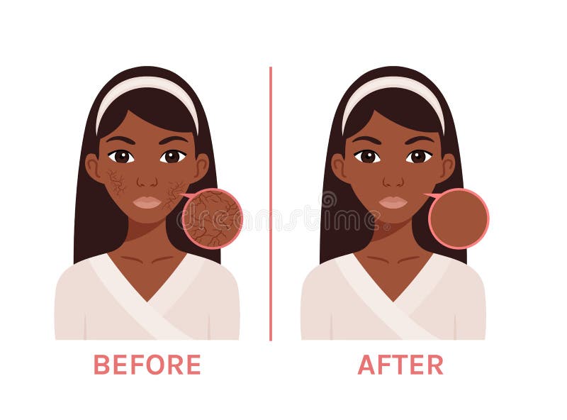 Dry Skin Problem Cartoon Stock Illustrations – 328 Dry Skin Problem Cartoon Stock Illustrations, Vectors & Clipart - Dreamstime Dry Skin Problem Cartoon Stock Illustrations – 328 Dry Skin Problem Cartoon Stock Illustrations, Vectors & Clipart - Dreamstime