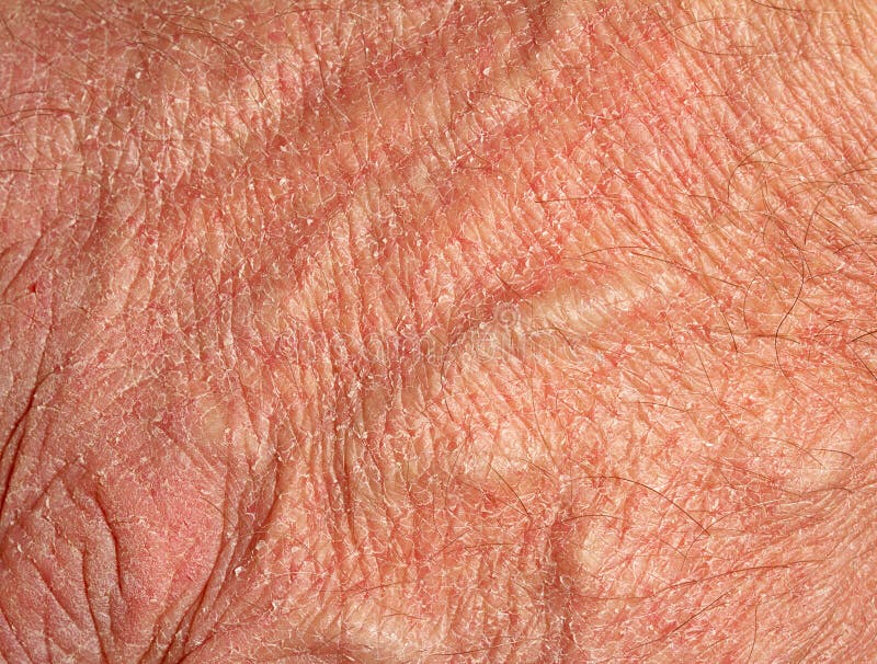 Dry skin on hand stock image. Image of detail, macro 18671845