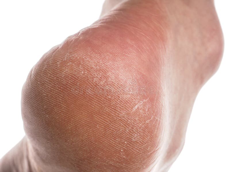 Dry skin on heel