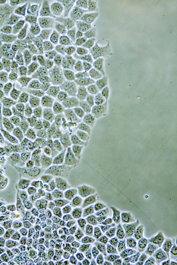 Ductal Breast Cancer cells stock image