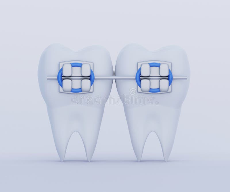 10 Pezzi Supporti Elastici In Gomma Per Ortodonzia - Applicatori Per Apparecchio Dentali - Foto 10