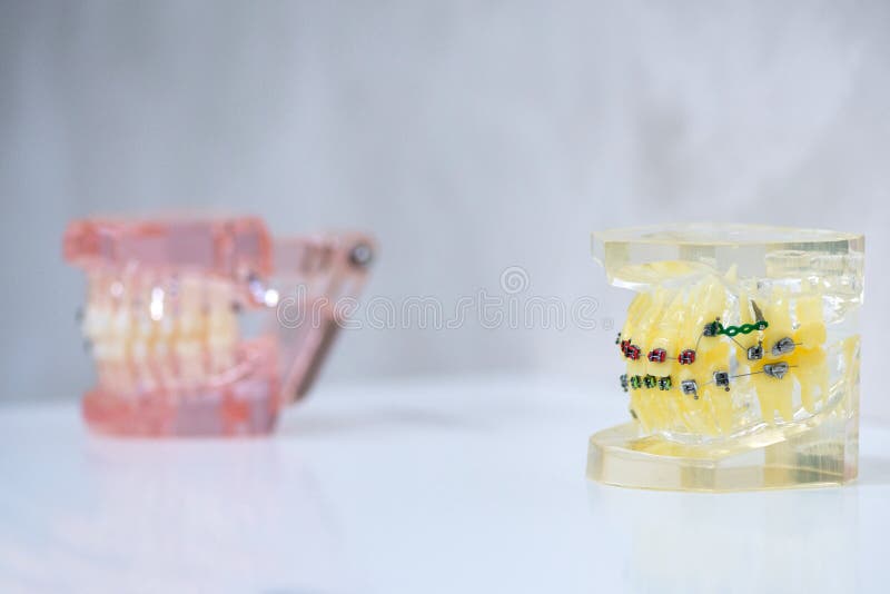 Mock Teeth with Braces. Demonstration Model of Teeth Editorial Photo