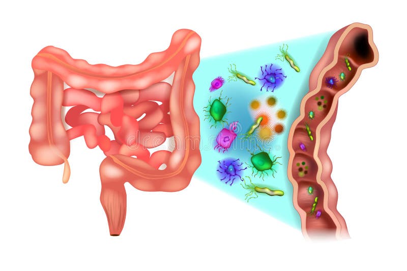 Dysbacteriosis van de darm - Dubbelpuntbacteriën vector illustratie Dysbacteriosis van de darm - Dubbelpuntbacteriën vector illustratie