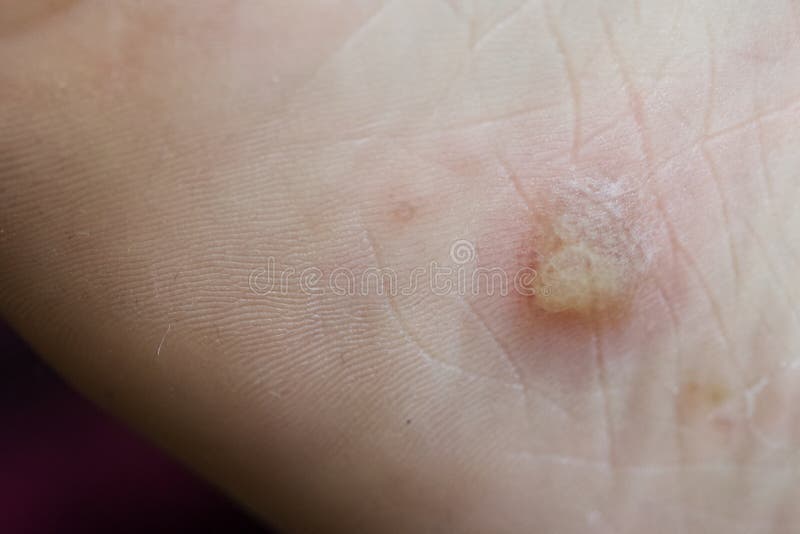 Dyshidrotic Eczema Also Known As Pompholyx Or Cheiropompholyx In The