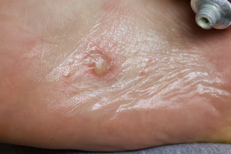 Dyshidrotic Eczema On The Foot Blister Dermatitis It Is Treated With