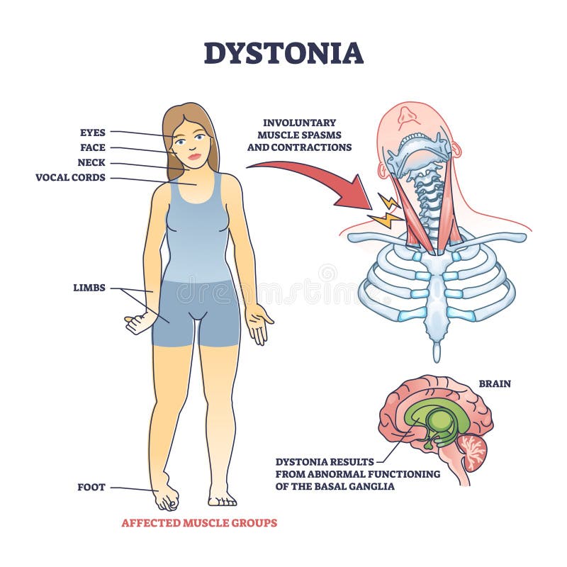 Dystonie Trouble Comme Spasmes Musculaires Anormaux Et ...