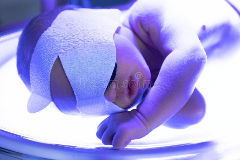 A small newly born baby with jaundice lies in the hospital under an ultraviolet lamp. A small newly born baby with jaundice lies in the hospital under an ultraviolet lamp.