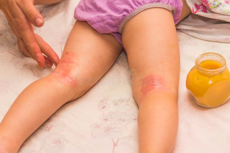 Dziecko na nodze, alergia, grzybowi płatki i zakrywający z a fotografia stock Dziecko na nodze, alergia, grzybowi płatki i zakrywający z a fotografia stock