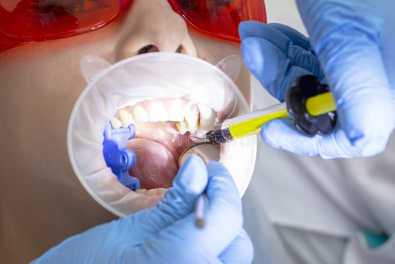 Dziewczyna na egzaminie przy dentysty traktowaniem próchnicowy ząb lekarka używa lustro na rękojeści i boron maszynie obrazy royalty free Dziewczyna na egzaminie przy dentysty traktowaniem próchnicowy ząb lekarka używa lustro na rękojeści i boron maszynie obrazy royalty free