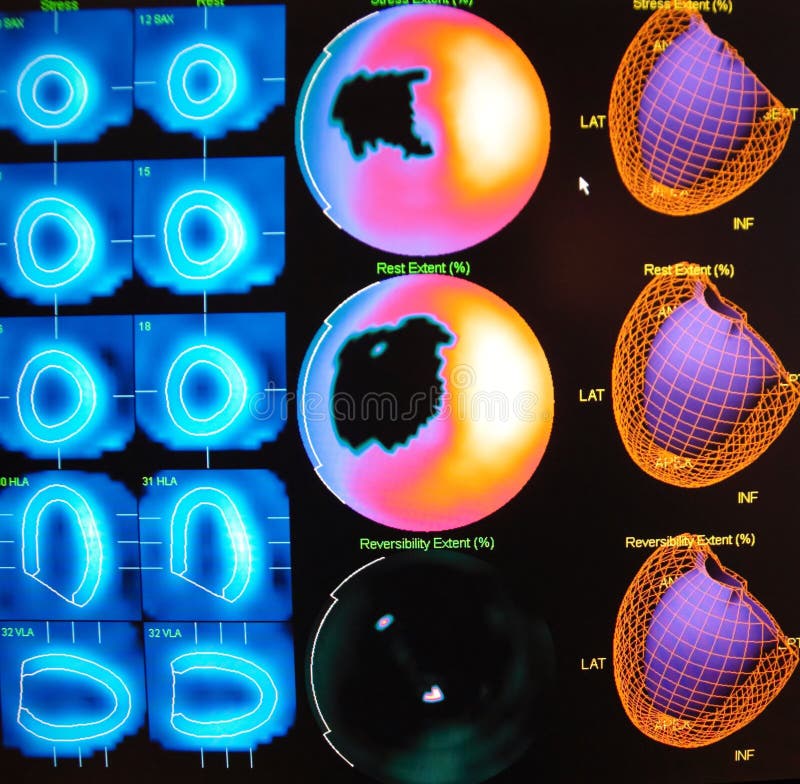 Myocardial perfusion nuclear scan , rest and stress part presented myocardial scar as evidence of heart attack in past , the black spots are on both parts of test in the same areas of upper and lower circles of image. Myocardial perfusion nuclear scan , rest and stress part presented myocardial scar as evidence of heart attack in past , the black spots are on both parts of test in the same areas of upper and lower circles of image