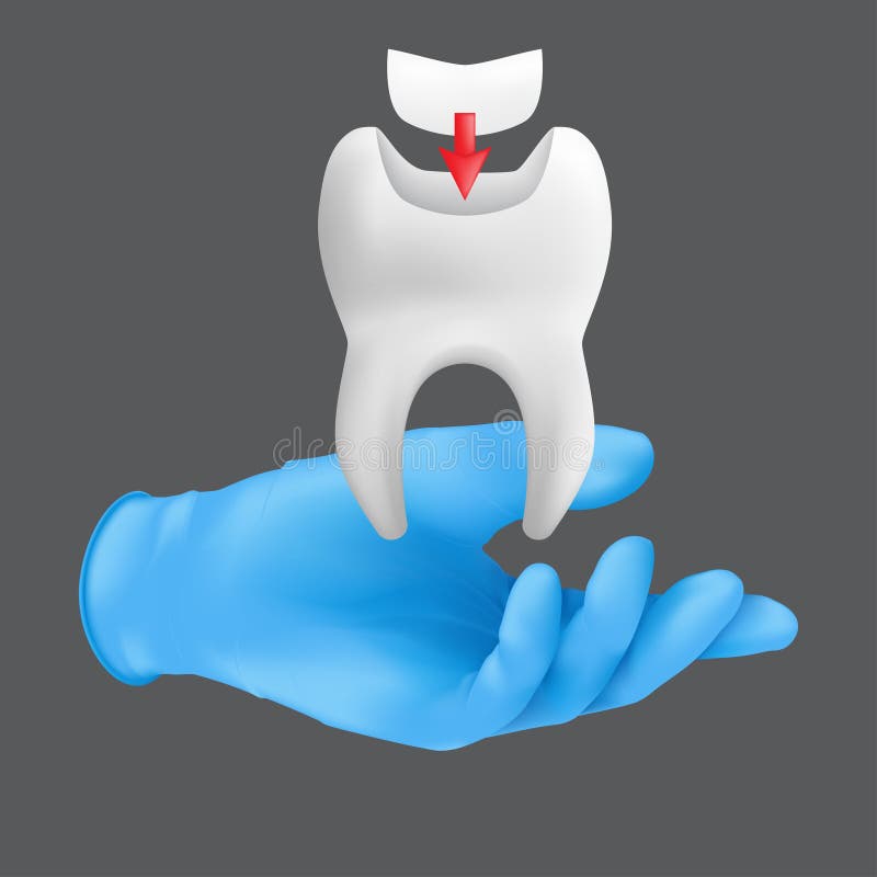 Dentist hand wearing blue protective surgical glove holding a ceramic model of the tooth. 3d realistic vector illustration of dental fillings concept isolated on a grey background. Dentist hand wearing blue protective surgical glove holding a ceramic model of the tooth. 3d realistic vector illustration of dental fillings concept isolated on a grey background