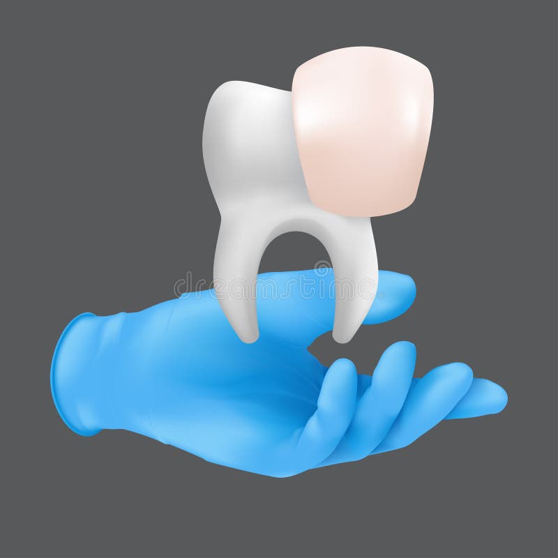 Dentist hand wearing blue protective surgical glove holding a ceramic model of the tooth. 3d realistic vector illustration of porcelain veneers concept isolated on a grey background. Dentist hand wearing blue protective surgical glove holding a ceramic model of the tooth. 3d realistic vector illustration of porcelain veneers concept isolated on a grey background