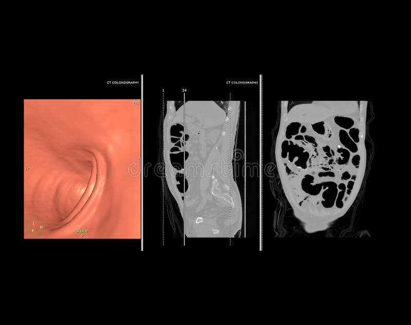 CT colonography or CT Scan of Colon 3D rendering image comparison with sagittal view vs Coronal view and on the screen. CT colonography or CT Scan of Colon 3D rendering image comparison with sagittal view vs Coronal view and on the screen