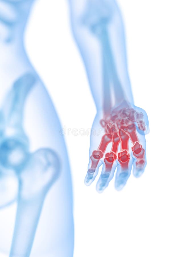 3d rendered medically accurate illustration of a painful hand. 3d rendered medically accurate illustration of a painful hand