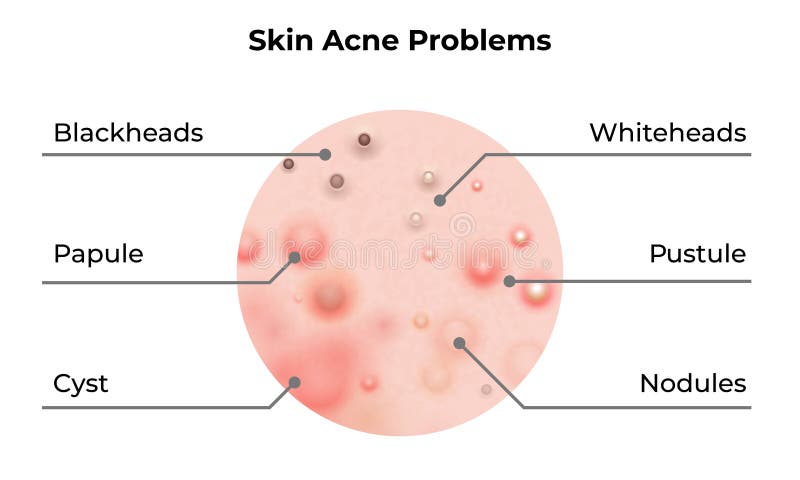 Skin acne types diagram. Vector skin problems disease, pimples blackheads and comedones, cosmetology and skincare treatment. Skin acne types diagram. Vector skin problems disease, pimples blackheads and comedones, cosmetology and skincare treatment