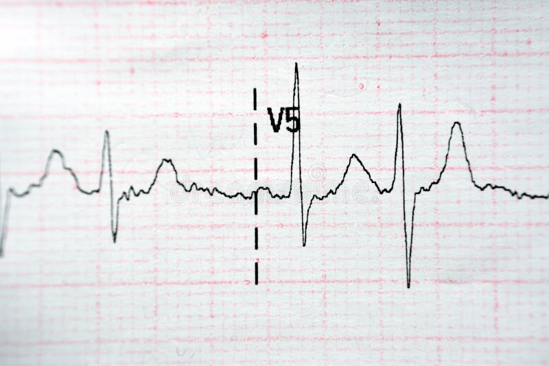 ECG ElectroCardioGraph paper that shows Normal Sinus Rhythm NSR with frequent PACs Premature Atrial Contractions, PVCs Premature Ventricular Contractions, lateral ST-T abnormality, myocardial ischemia