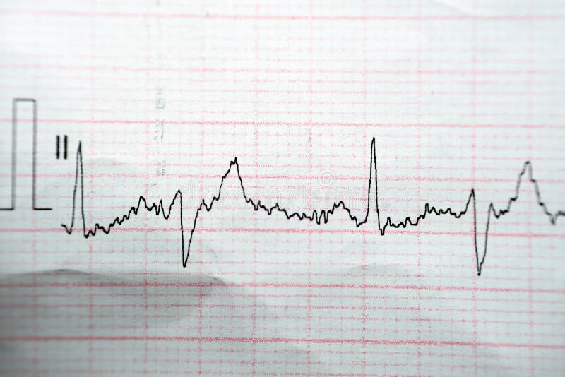 ECG ElectroCardioGraph paper that shows Normal Sinus Rhythm NSR with frequent PACs Premature Atrial Contractions, PVCs Premature Ventricular Contractions, lateral ST-T abnormality, myocardial ischemia