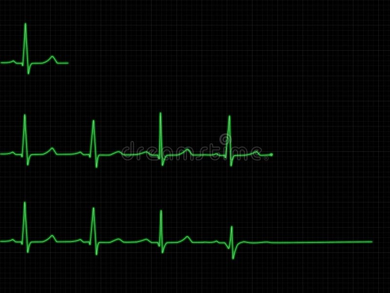 1st row - one cycle of normal (physiological) ECG 2nd row - normal ECG terminated with a heart symbol 3rd row - ECG with descending amplitude, broken QRS complex and finally asystole. 1st row - one cycle of normal (physiological) ECG 2nd row - normal ECG terminated with a heart symbol 3rd row - ECG with descending amplitude, broken QRS complex and finally asystole