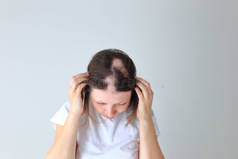 Echtes Alopecia areata in einem jungen Mädchen. ein Kahlkopf in einer Person.