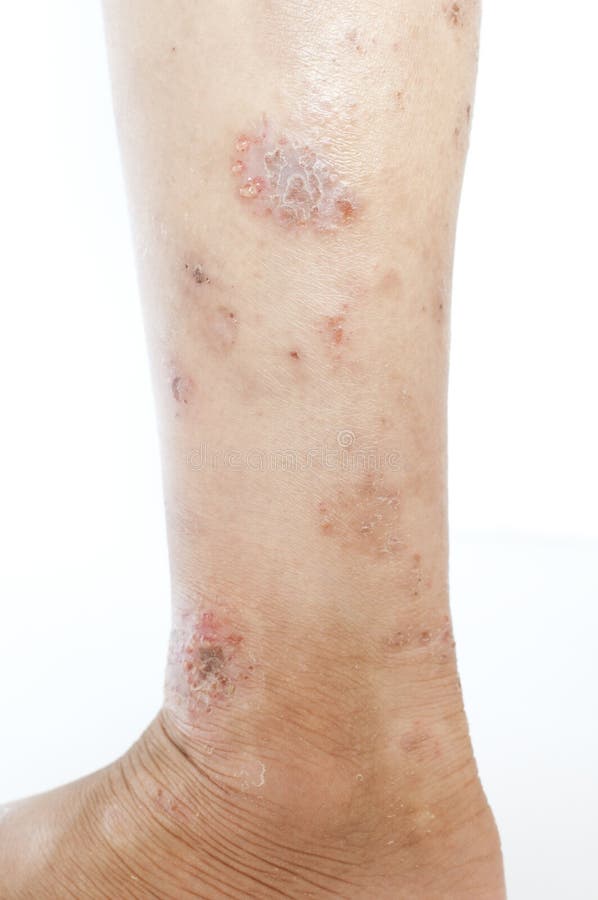 Eczema on leg stock photo. Image of rash, flaky, cracked 64806956