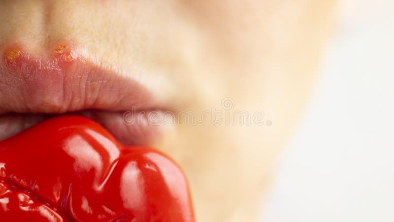Een deel van een jong vrouwengezicht met rode bellen van virusherpes op lippen die zij probeert om met stuk speelgoed lippen voor royalty-vrije stock foto Een deel van een jong vrouwengezicht met rode bellen van virusherpes op lippen die zij probeert om met stuk speelgoed lippen voor royalty-vrije stock foto