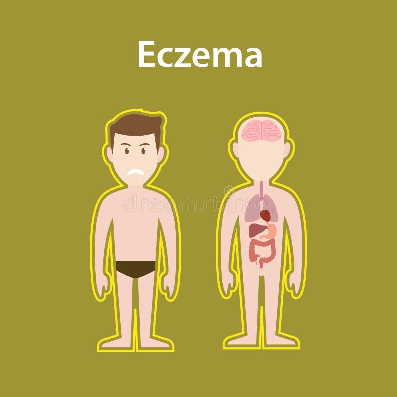 Egzemy chora ilustracja z ciało ludzkie folującym statywowym i organowym ochrona znakiem ilustracji Egzemy chora ilustracja z ciało ludzkie folującym statywowym i organowym ochrona znakiem ilustracji