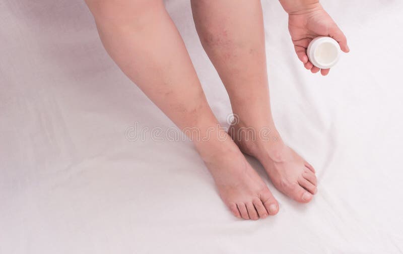 Beine Einer Alten Frau Auf Einem Weissen Hintergrund Mit Krampfadern Auf Den Beinen Phlebeurysm Anatomie Stockfoto Bild Von Hintergrund Krampfadern