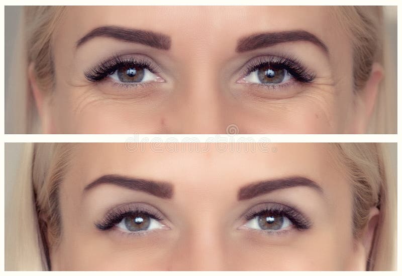 Einspritzungen von botox Vorher und nachher stockfotografie Einspritzungen von botox Vorher und nachher stockfotografie