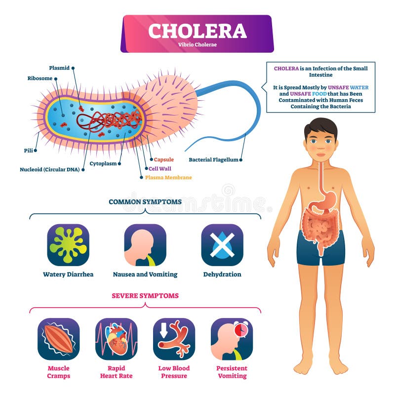 Ejemplo del vector del cólera Estructura de la infección y esquema etiquetados del síntoma libre illustration Ejemplo del vector del cólera Estructura de la infección y esquema etiquetados del síntoma libre illustration
