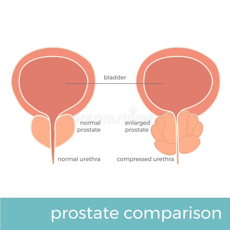 Ejemplo del vector de la próstata normal y agrandada