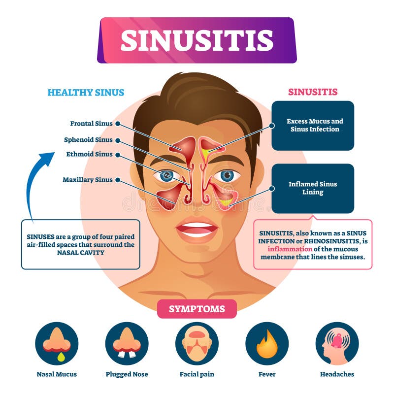 Sinusitis vector illustration. Labeled rhinosinusitis inflammation scheme. Anatomical explanation with healthy and infection nasal illness comparison, symptoms list and educational disease infographic. Sinusitis vector illustration. Labeled rhinosinusitis inflammation scheme. Anatomical explanation with healthy and infection nasal illness comparison, symptoms list and educational disease infographic