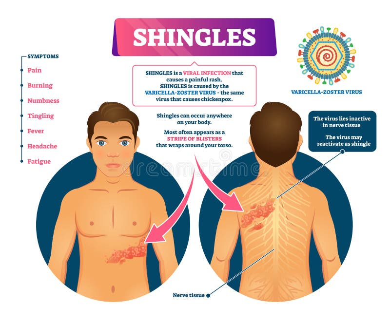 Shingles vector illustration. Labeled medical skin virus explanation scheme. Varicella zoster illness symptoms list with stripe of blisters appearance. Infogarphic with nerve tissue epidermis disorder. Shingles vector illustration. Labeled medical skin virus explanation scheme. Varicella zoster illness symptoms list with stripe of blisters appearance. Infogarphic with nerve tissue epidermis disorder