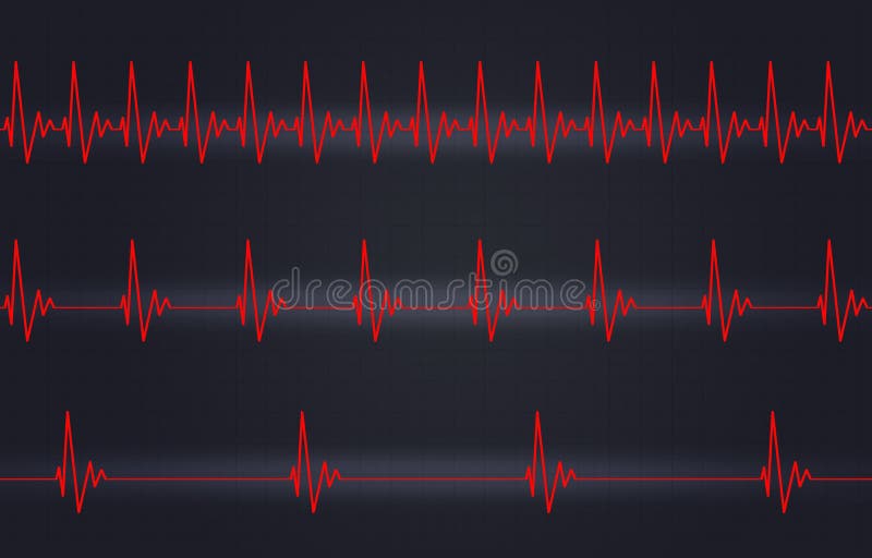 Ejemplo lento normal rápido del latido del corazón libre illustration Ejemplo lento normal rápido del latido del corazón libre illustration