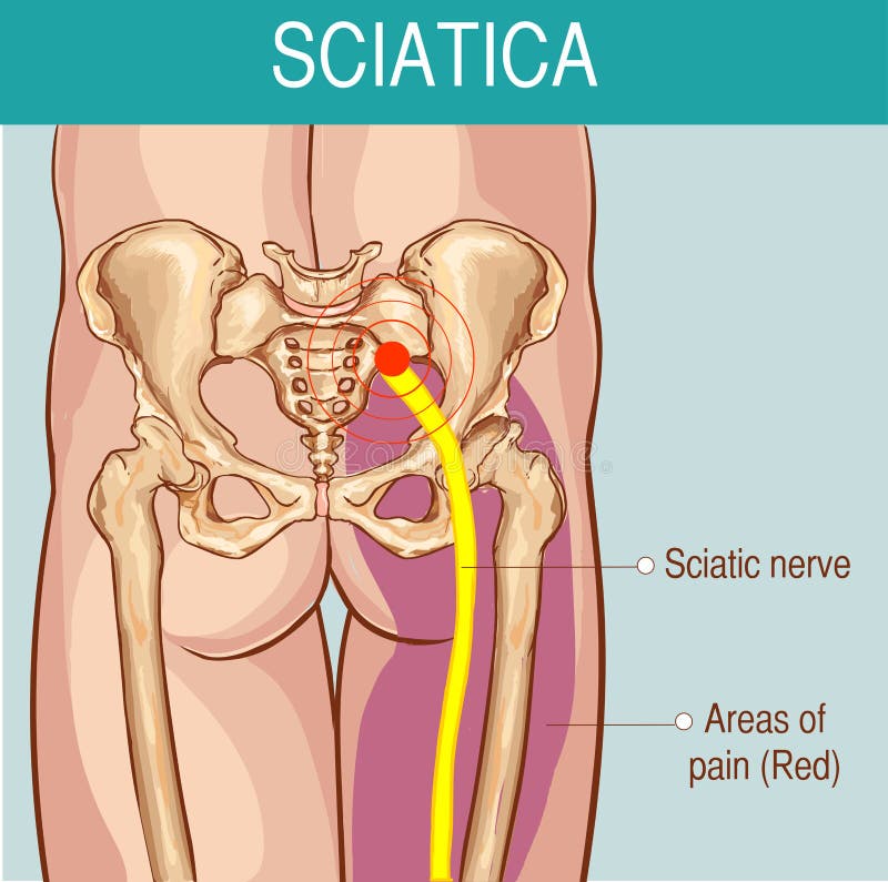 Ejemplo médico de síntomas de la ciática ilustración del vector Ejemplo médico de síntomas de la ciática ilustración del vector