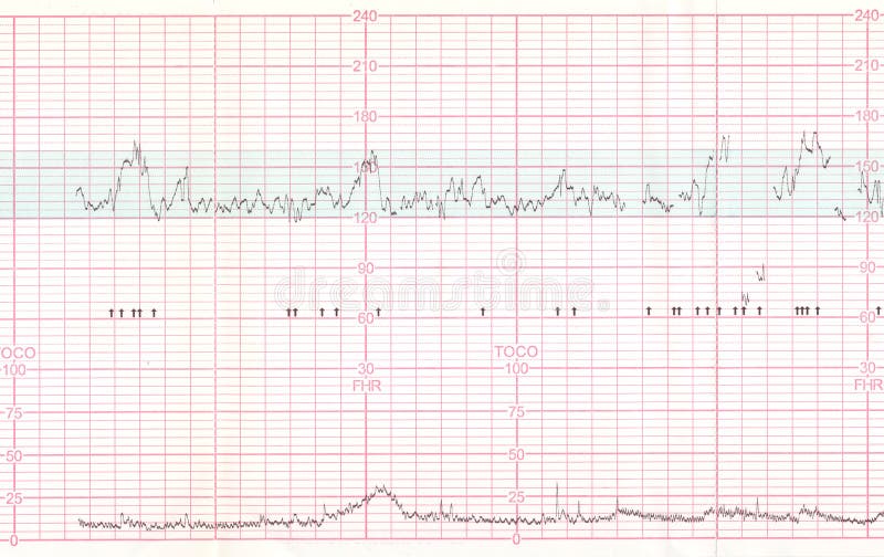 Ekg Ecg Result Treadmill Stress Test Stock Photos Free & RoyaltyFree