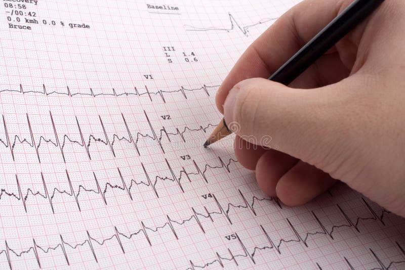 EKG or ECG Result from a Treadmill Stress Test Stock Photo Image of