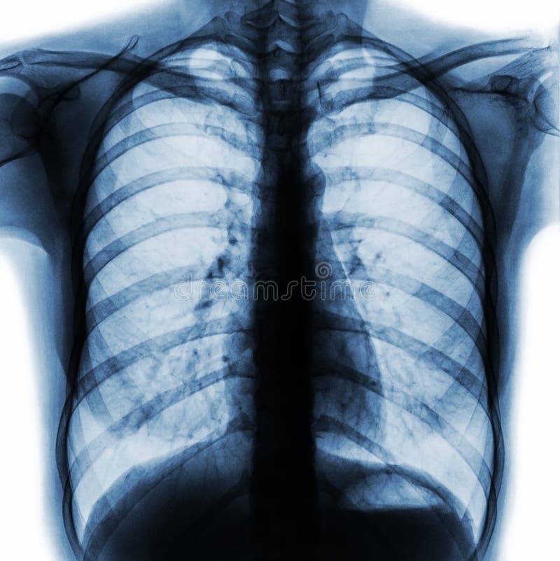 Ekranowego klatki piersiowej promieniowania rentgenowskiego PA pionowego przedstawienia normalna ludzka klatka piersiowa