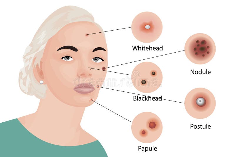El acné mecanografía cosmetología stock de ilustración El acné mecanografía cosmetología stock de ilustración