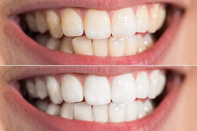 El blanquear de Person Teeth Before And After