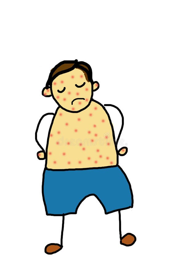 El niño pequeño está enfermo con varicela ilustración del vector El niño pequeño está enfermo con varicela ilustración del vector