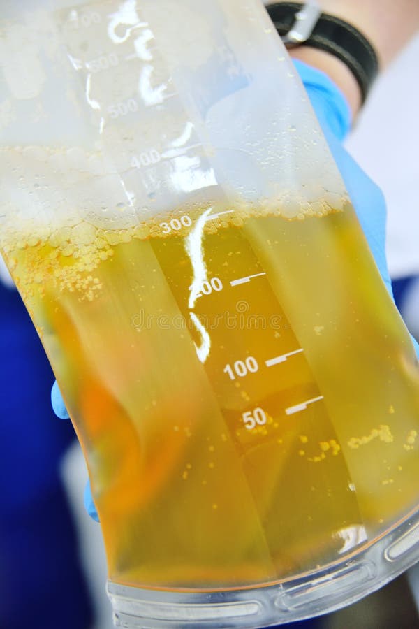 El procedimiento de la purificación de la sangre y del plasma de las toxinas foto de archivo El procedimiento de la purificación de la sangre y del plasma de las toxinas foto de archivo