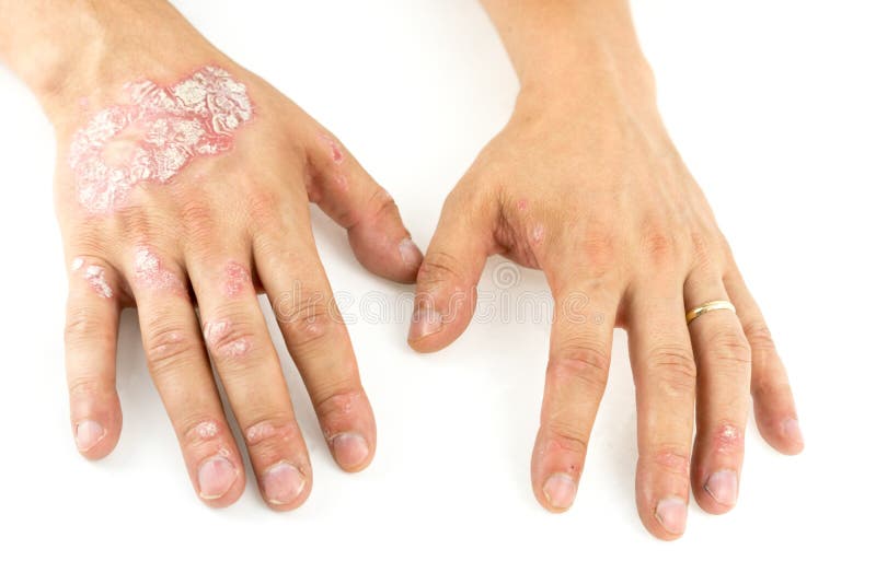 El psoriasis vulgaris en sirve las manos con la placa, la erupción y los remiendos, aislados en el fondo blanco Enfermedad genéti fotografía de archivo El psoriasis vulgaris en sirve las manos con la placa, la erupción y los remiendos, aislados en el fondo blanco Enfermedad genéti fotografía de archivo