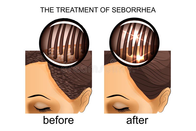 El tratamiento del seborrhea del cuero cabelludo Antes y después ilustración del vector El tratamiento del seborrhea del cuero cabelludo Antes y después ilustración del vector