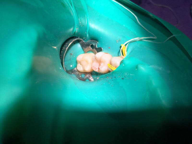 El tratamiento pulpotomy o de la endodoncia parcial en la muela t del ` s del niño fotografía de archivo El tratamiento pulpotomy o de la endodoncia parcial en la muela t del ` s del niño fotografía de archivo